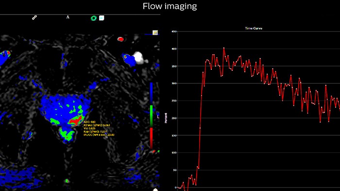 Images from multiparametric MRI of a classic peripheral zone lesion in the prostate