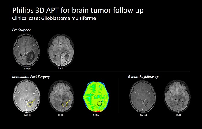 Brain Tumor