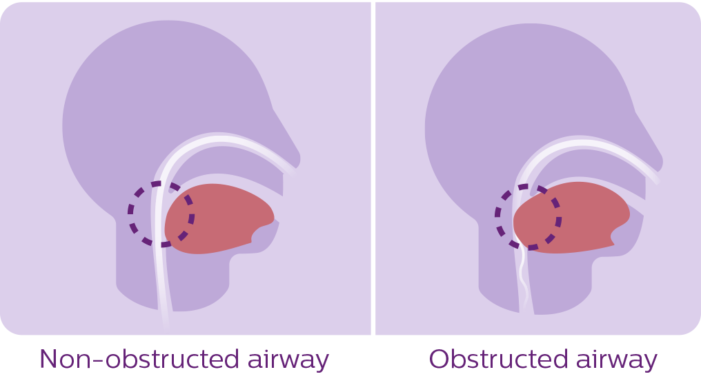 sleep apnea diagram