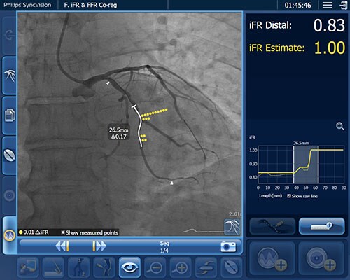 iFR Co-registration