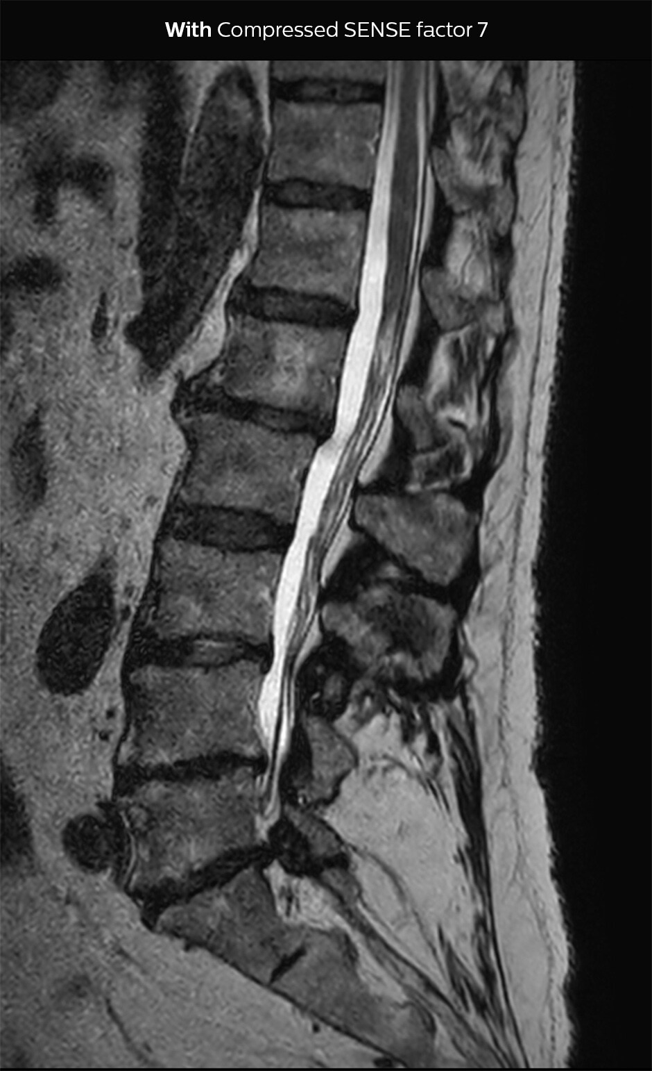 3D T2 SpineVIEW lumbar spine Compressed SENSE factor7