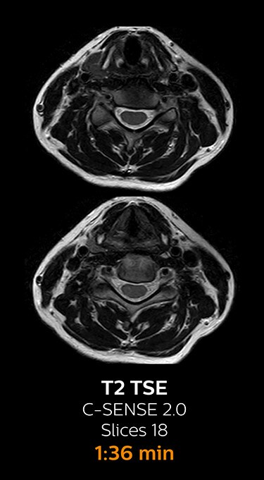 T2 TSE ax magnetic resonance imaging