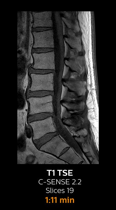 T1 TSE magnetic resonance