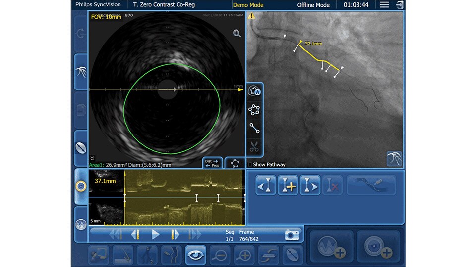 IVUS co-registration visuals