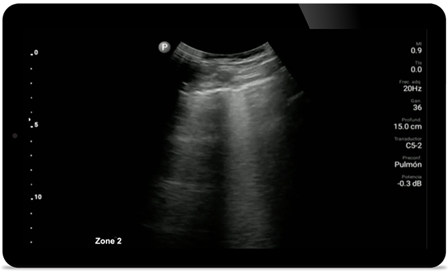 Keep an eye on COVID pneumonia