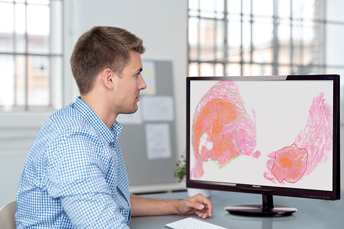 Download image (.jpg) Philips TissueMark aids in identifying insufficient samples for molecular tests with accurate cellularity guidance.